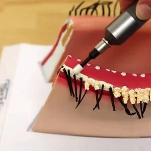 A BlephEx tool being used on a model of an eye to show how treatment works