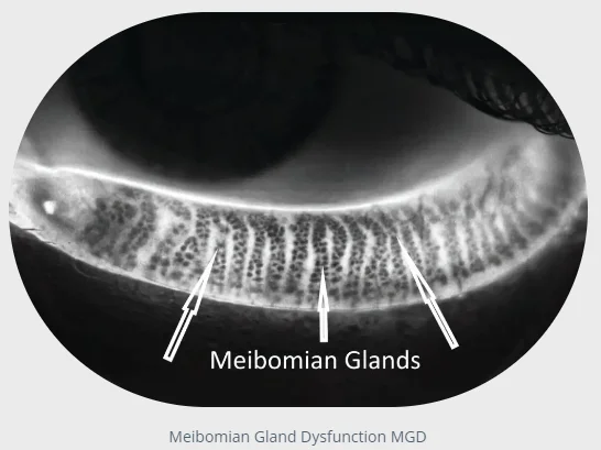 A close-up image of an eye's meibomian glands